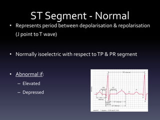 ST Segment - Normal
• Represents period between depolarisation & repolarisation
(J point toT wave)
• Normally isoelectric with respect toTP & PR segment
• Abnormal if:
– Elevated
– Depressed
 