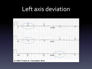 Left axis deviation
 