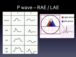 P wave – RAE / LAE
 