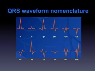 QRS waveform nomenclature
R r qR qRs Qrs QS
Qr Rs rS qs rSr’ rSR’
 