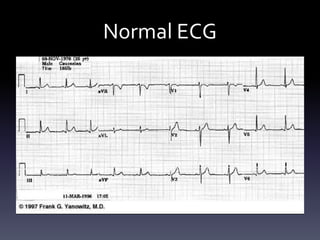 Normal ECG
 
