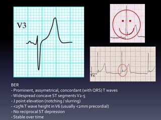 BER
- Prominent, assymetrical, concordant (with QRS)T waves
-Widespread concave ST segmentsV2-5
- J point elevation (notching / slurring)
- <25%T wave height inV6 (usually <2mm precordial)
- No reciprocal ST depression
- Stable over time
 