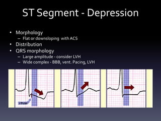 ST Segment - Depression
• Morphology
– Flat or downsloping with ACS
• Distribution
• QRS morphology
– Large amplitude - consider LVH
– Wide complex - BBB, vent. Pacing, LVH
 