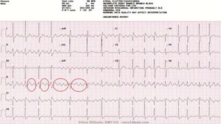 ECG interpretation in emergency settings | PPTX