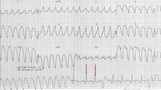 ECG interpretation in emergency settings | PPTX