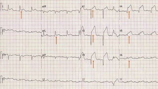 ECG interpretation in emergency settings | PPTX