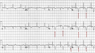ECG interpretation in emergency settings | PPTX