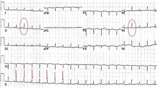 ECG interpretation in emergency settings | PPTX