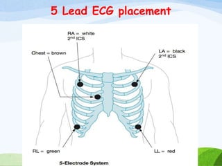 5 Lead ECG placement
 