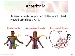 Marc Imhotep Cray, M.D.
Anterior MI
101
• Remember anterior portion of the heart is best
viewed using leads V1- V4
Limb Leads Augmented Leads Precordial Leads
 