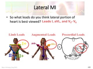 Marc Imhotep Cray, M.D.
Lateral MI
102
• So what leads do you think lateral portion of
heart is best viewed?
Limb Leads Augmented Leads Precordial Leads
Leads I, aVL, and V5- V6
 