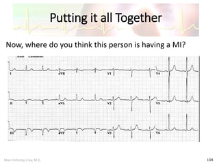 Marc Imhotep Cray, M.D.
Putting it all Together
104
Now, where do you think this person is having a MI?
 
