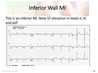 Marc Imhotep Cray, M.D.
Inferior Wall MI
105
This is an inferior MI. Note ST elevation in leads II, III
and aVF
 