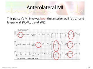Marc Imhotep Cray, M.D.
Anterolateral MI
107
This person’s MI involves both the anterior wall (V2-V4) and
lateral wall (V5-V6, I, and aVL)!
 