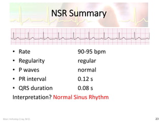 Marc Imhotep Cray, M.D.
NSR Summary
23
• Rate 90-95 bpm
• Regularity regular
• P waves normal
• PR interval 0.12 s
• QRS duration 0.08 s
Interpretation? Normal Sinus Rhythm
 