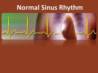 Normal Sinus Rhythm
 