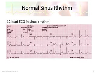Marc Imhotep Cray, M.D.
Normal Sinus Rhythm
27
12 lead ECG in sinus rhythm
 