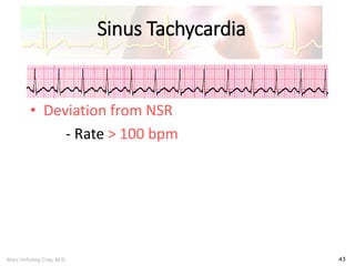 Marc Imhotep Cray, M.D.
Sinus Tachycardia
43
• Deviation from NSR
- Rate > 100 bpm
 