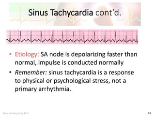 Marc Imhotep Cray, M.D.
Sinus Tachycardia cont’d.
44
• Etiology: SA node is depolarizing faster than
normal, impulse is conducted normally
• Remember: sinus tachycardia is a response
to physical or psychological stress, not a
primary arrhythmia.
 