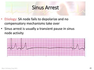 Marc Imhotep Cray, M.D.
Sinus Arrest
45
• Etiology: SA node fails to depolarize and no
compensatory mechanisms take over
• Sinus arrest is usually a transient pause in sinus
node activity
 