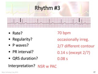 Marc Imhotep Cray, M.D.
Rhythm #3
47
70 bpm• Rate?
• Regularity? occasionally irreg.
2/7 different contour
0.08 s
• P waves?
• PR interval? 0.14 s (except 2/7)
• QRS duration?
Interpretation? NSR w PAC
 