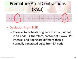 Marc Imhotep Cray, M.D.
Premature Atrial Contractions
(PACs)
48
• Deviation from NSR
– These ectopic beats originate in atria (but not
in SA node) therefore, contour of P wave, PR
interval, and timing are different than a
normally generated pulse from SA node
 