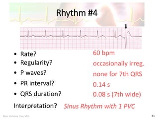 Marc Imhotep Cray, M.D.
Rhythm #4
51
60 bpm• Rate?
• Regularity? occasionally irreg.
none for 7th QRS
0.08 s (7th wide)
• P waves?
• PR interval? 0.14 s
• QRS duration?
Interpretation? Sinus Rhythm with 1 PVC
 