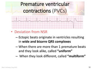 Marc Imhotep Cray, M.D.
Premature ventricular
contractions (PVCs)
52
• Deviation from NSR
– Ectopic beats originate in ventricles resulting
in wide and bizarre QRS complexes
– When there are more than 1 premature beats
and they look alike, called “uniform”
– When they look different, called “multiform”
 