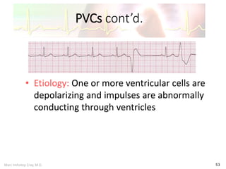 Marc Imhotep Cray, M.D.
PVCs cont’d.
53
• Etiology: One or more ventricular cells are
depolarizing and impulses are abnormally
conducting through ventricles
 
