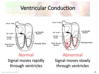 Marc Imhotep Cray, M.D.
Ventricular Conduction
55
Normal
Signal moves rapidly
through ventricles
Abnormal
Signal moves slowly
through ventricles
 