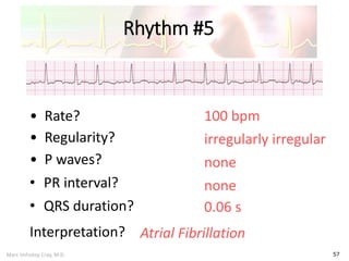 Marc Imhotep Cray, M.D.
Rhythm #5
57
100 bpm• Rate?
• Regularity? irregularly irregular
none
0.06 s
• P waves?
• PR interval? none
• QRS duration?
Interpretation? Atrial Fibrillation
 