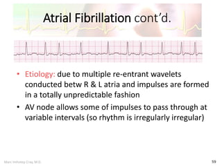 Marc Imhotep Cray, M.D.
Atrial Fibrillation cont’d.
59
• Etiology: due to multiple re-entrant wavelets
conducted betw R & L atria and impulses are formed
in a totally unpredictable fashion
• AV node allows some of impulses to pass through at
variable intervals (so rhythm is irregularly irregular)
 