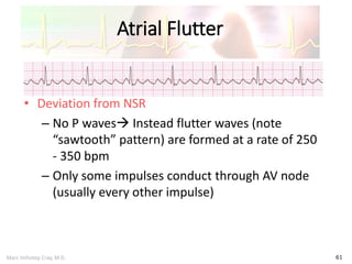 Marc Imhotep Cray, M.D.
Atrial Flutter
61
• Deviation from NSR
– No P waves Instead flutter waves (note
“sawtooth” pattern) are formed at a rate of 250
- 350 bpm
– Only some impulses conduct through AV node
(usually every other impulse)
 