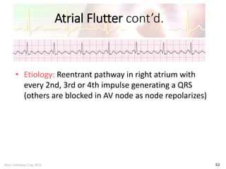 Marc Imhotep Cray, M.D.
Atrial Flutter cont’d.
62
• Etiology: Reentrant pathway in right atrium with
every 2nd, 3rd or 4th impulse generating a QRS
(others are blocked in AV node as node repolarizes)
 