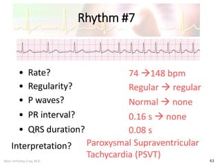 Marc Imhotep Cray, M.D.
Rhythm #7
63
74 148 bpm• Rate?
• Regularity? Regular  regular
Normal  none
0.08 s
• P waves?
• PR interval? 0.16 s  none
• QRS duration?
Interpretation? Paroxysmal Supraventricular
Tachycardia (PSVT)
 