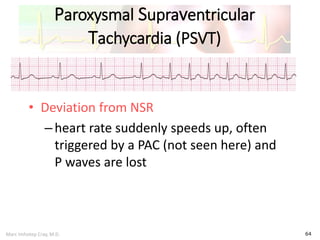 Marc Imhotep Cray, M.D.
Paroxysmal Supraventricular
Tachycardia (PSVT)
64
• Deviation from NSR
–heart rate suddenly speeds up, often
triggered by a PAC (not seen here) and
P waves are lost
 