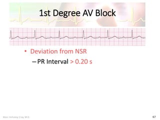 Marc Imhotep Cray, M.D.
1st Degree AV Block
67
• Deviation from NSR
–PR Interval > 0.20 s
 