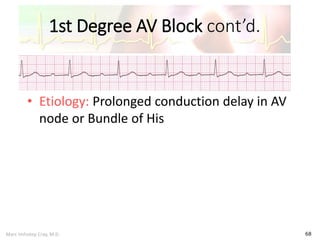 Marc Imhotep Cray, M.D.
1st Degree AV Block cont’d.
68
• Etiology: Prolonged conduction delay in AV
node or Bundle of His
 