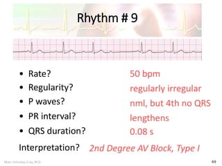 Marc Imhotep Cray, M.D.
Rhythm # 9
69
50 bpm• Rate?
• Regularity? regularly irregular
nml, but 4th no QRS
0.08 s
• P waves?
• PR interval? lengthens
• QRS duration?
Interpretation? 2nd Degree AV Block, Type I
 