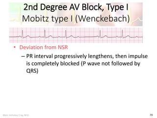 Marc Imhotep Cray, M.D.
2nd Degree AV Block, Type I
Mobitz type I (Wenckebach)
70
• Deviation from NSR
– PR interval progressively lengthens, then impulse
is completely blocked (P wave not followed by
QRS)
 