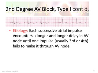 Marc Imhotep Cray, M.D.
2nd Degree AV Block, Type I cont’d.
71
• Etiology: Each successive atrial impulse
encounters a longer and longer delay in AV
node until one impulse (usually 3rd or 4th)
fails to make it through AV node
 