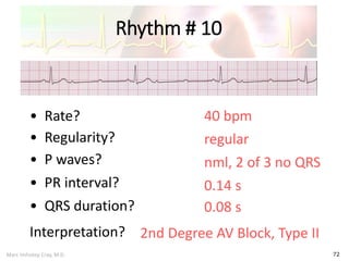 Marc Imhotep Cray, M.D.
Rhythm # 10
72
40 bpm• Rate?
• Regularity? regular
nml, 2 of 3 no QRS
0.08 s
• P waves?
• PR interval? 0.14 s
• QRS duration?
Interpretation? 2nd Degree AV Block, Type II
 