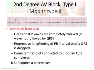 Marc Imhotep Cray, M.D.
2nd Degree AV Block, Type II
Mobitz type II
73
• Deviation from NSR
– Occasional P waves are completely blocked (P
wave not followed by QRS)
– Progressive lengthening of PR interval until a QRS
is dropped
– Consistent ratio of conducted to dropped QRS
complexes
NB: Requires a pacemaker
 