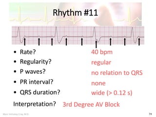 Marc Imhotep Cray, M.D.
Rhythm #11
74
40 bpm• Rate?
• Regularity? regular
no relation to QRS
wide (> 0.12 s)
• P waves?
• PR interval? none
• QRS duration?
Interpretation? 3rd Degree AV Block
 