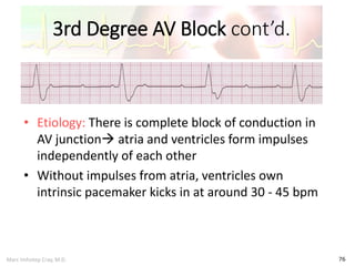 Marc Imhotep Cray, M.D.
3rd Degree AV Block cont’d.
76
• Etiology: There is complete block of conduction in
AV junction atria and ventricles form impulses
independently of each other
• Without impulses from atria, ventricles own
intrinsic pacemaker kicks in at around 30 - 45 bpm
 