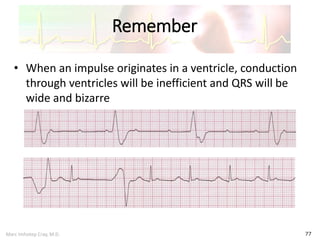 Marc Imhotep Cray, M.D.
Remember
77
• When an impulse originates in a ventricle, conduction
through ventricles will be inefficient and QRS will be
wide and bizarre
 