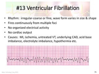 Marc Imhotep Cray, M.D.
#13 Ventricular Fibrillation
79
• Rhythm: irregular-coarse or fine, wave form varies in size & shape
• Fires continuously from multiple foci
• No organized electrical activity
• No cardiac output
• Causes: MI, ischemia, untreated VT, underlying CAD, acid base
imbalance, electrolyte imbalance, hypothermia etc.
 