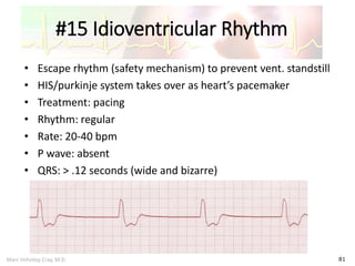 Marc Imhotep Cray, M.D.
#15 Idioventricular Rhythm
81
• Escape rhythm (safety mechanism) to prevent vent. standstill
• HIS/purkinje system takes over as heart’s pacemaker
• Treatment: pacing
• Rhythm: regular
• Rate: 20-40 bpm
• P wave: absent
• QRS: > .12 seconds (wide and bizarre)
 