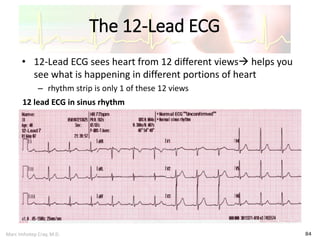 Marc Imhotep Cray, M.D.
The 12-Lead ECG
84
• 12-Lead ECG sees heart from 12 different views helps you
see what is happening in different portions of heart
– rhythm strip is only 1 of these 12 views
12 lead ECG in sinus rhythm
 