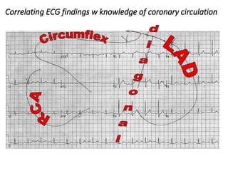 Correlating ECG findings w knowledge of coronary circulation
 